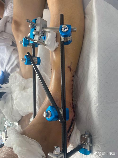 山西运城骨科矫形医院有何特色？-图3